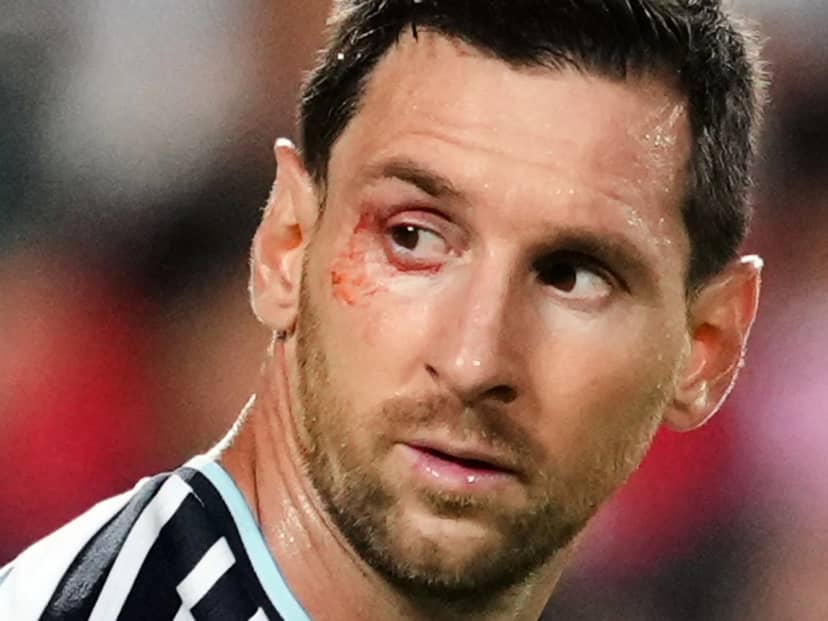 Messi y un sorprendente sangrado en su ojo durante el Argentina-Suiza