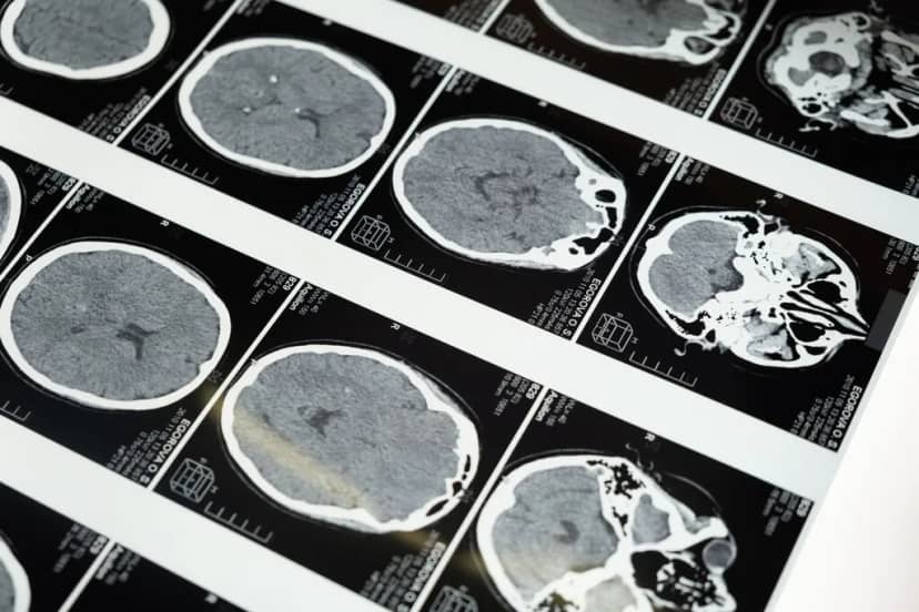 No es solo cuestión de cumplir años: la mala salud metabólica envejece tu cerebro por una vía completamente independiente
