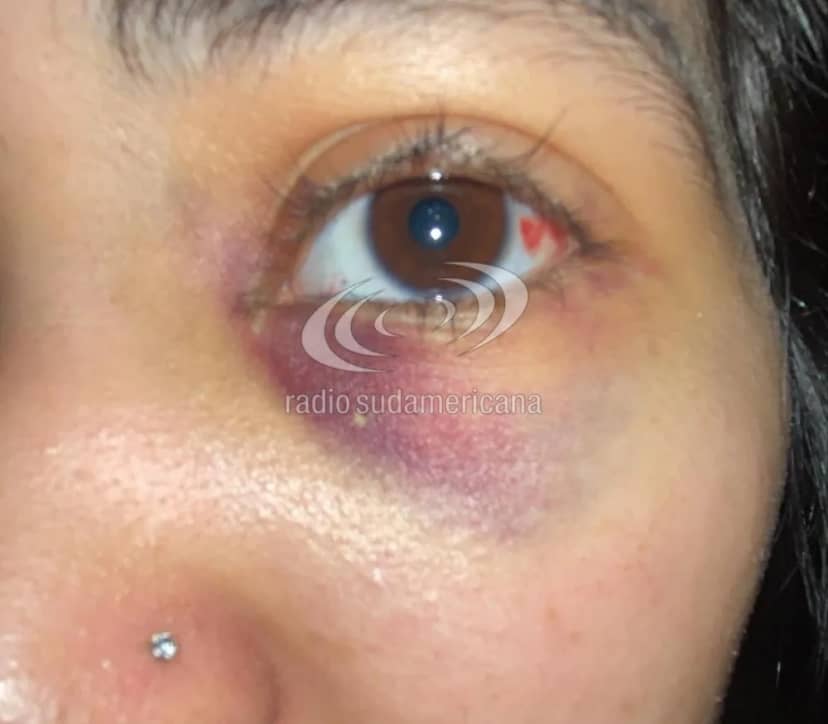 Denunció que su compañera la noqueó en el patio de la Escuela