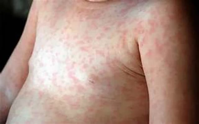 Sarampión: advierten sobre el riesgo de contagio en viajeros del exterior
