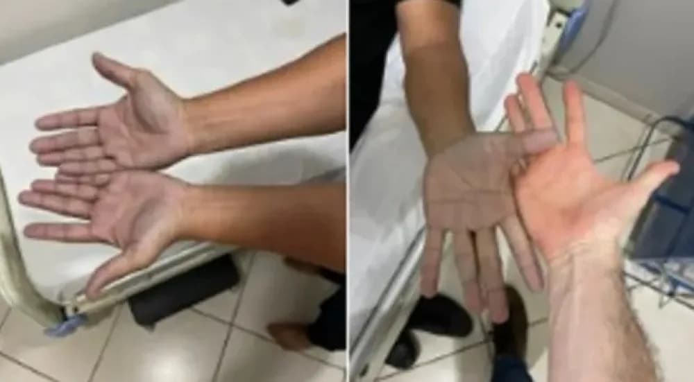 Fue a la guardia con las manos azules, asustó a los médicos y el diagnóstico fue insólito