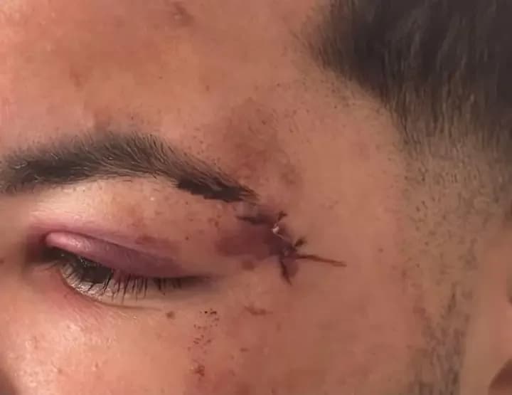 Brutal ataque con hondas: hirieron a un joven en un presunto intento de robo