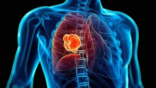 Qué son los nódulos pulmonares, la lesión por la que será operado el papa León XIV