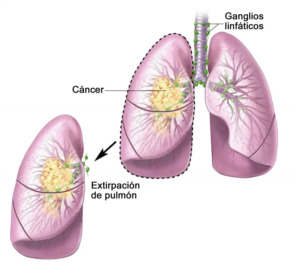 Qué es un adenocarcinoma pulmonar: síntomas, causas y tratamientos
