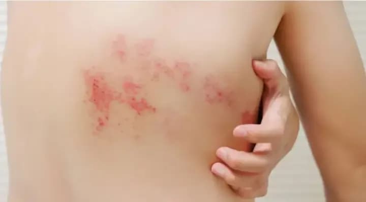 Brote de varicela en Neuquén: elevaron a 24 casos y activaron protocolos de prevención